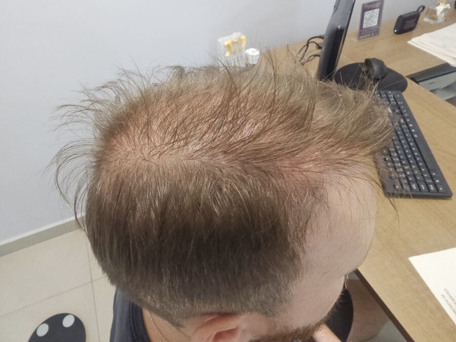 Tratamento capilar: antes