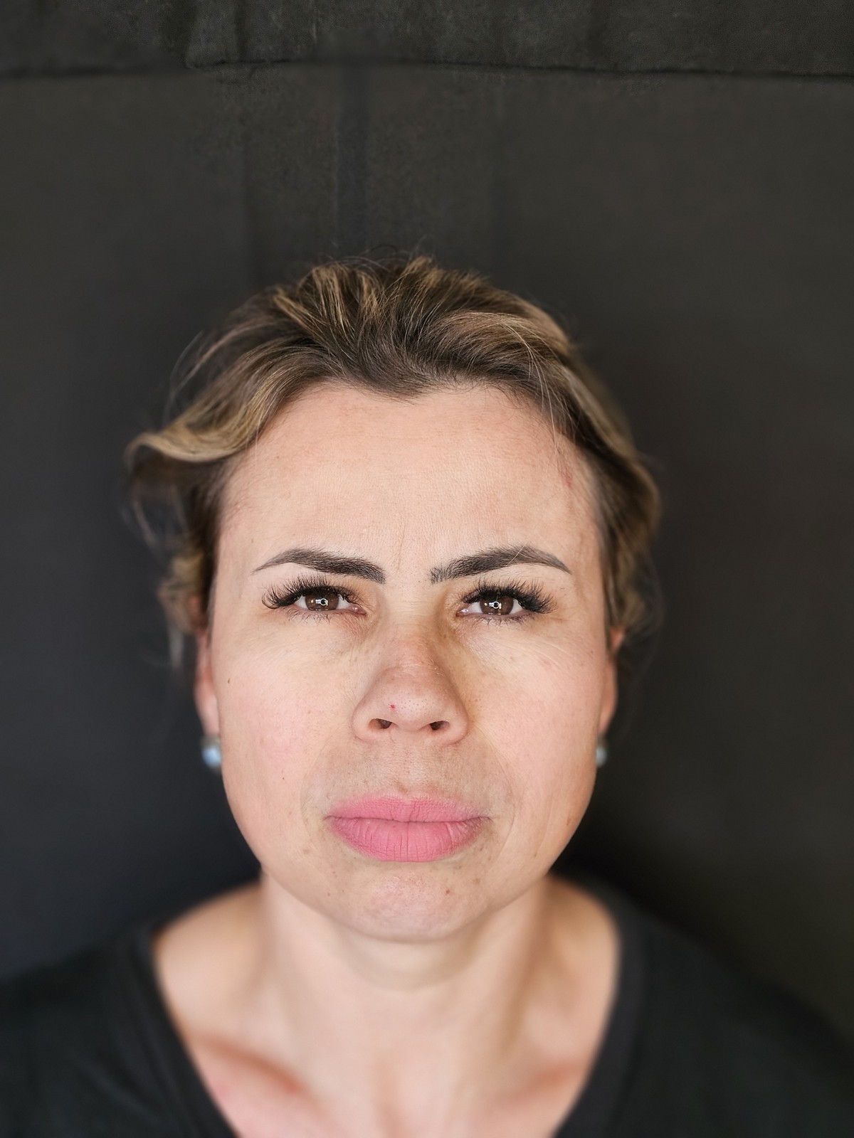Estética facial: depois