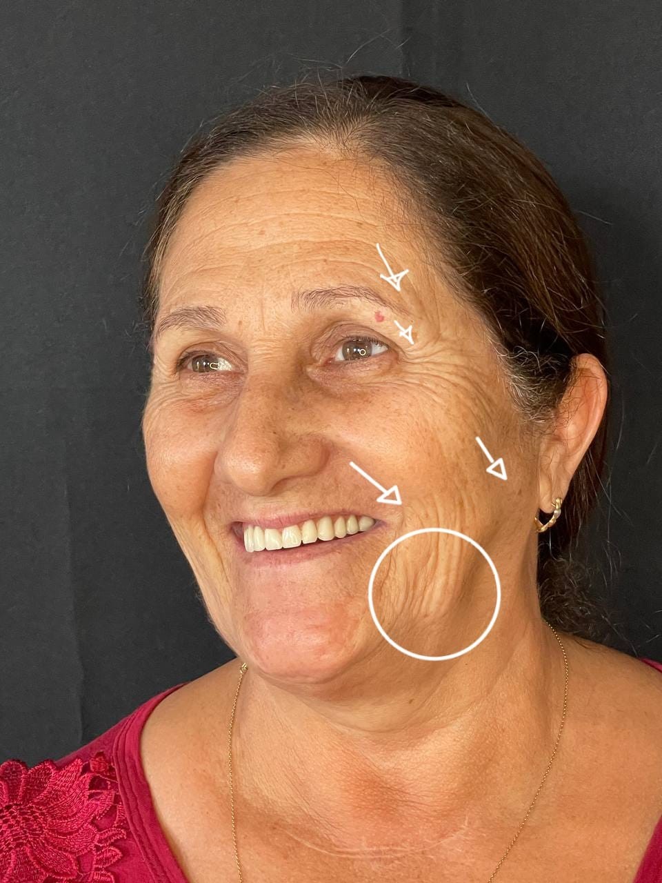 Estética facial: antes