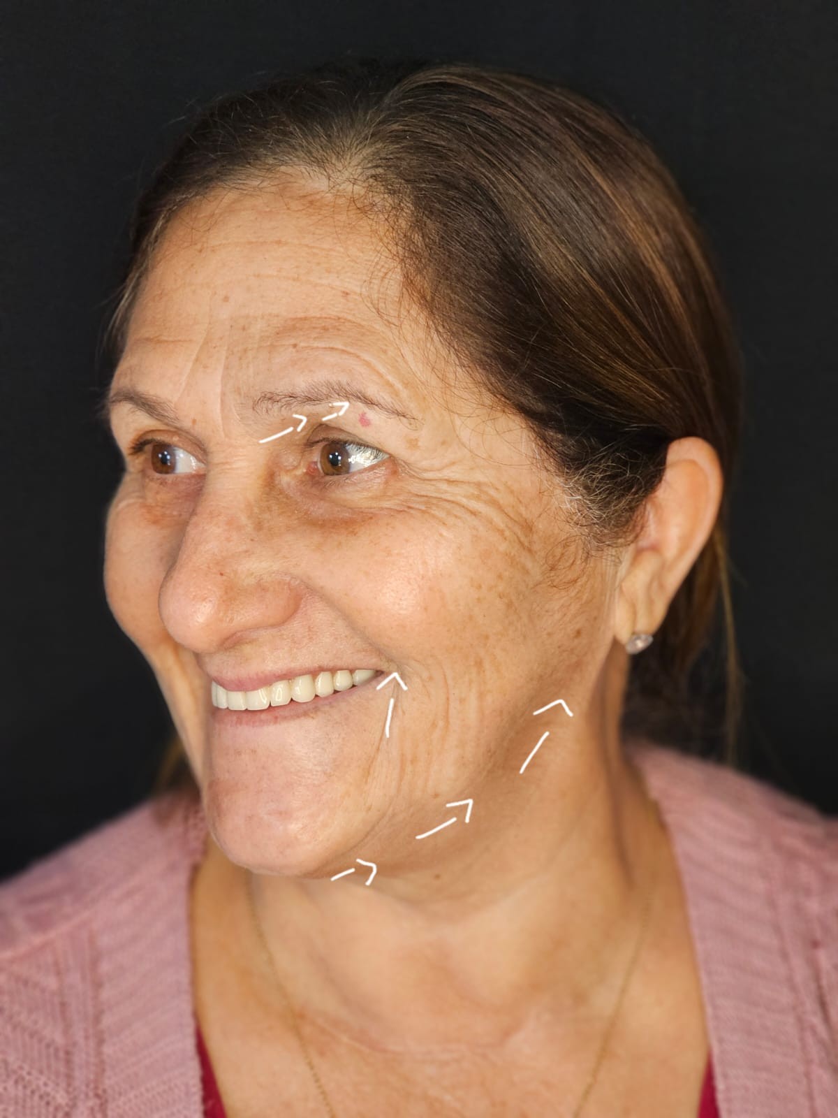 Estética facial: depois