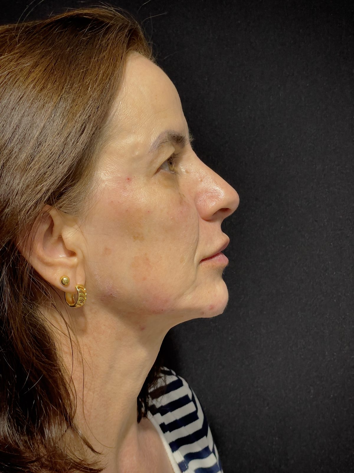 Estética facial: depois