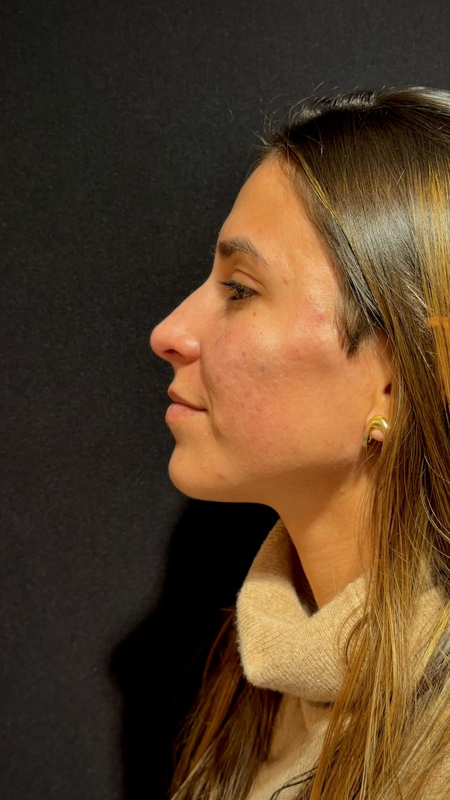 Estética facial: depois