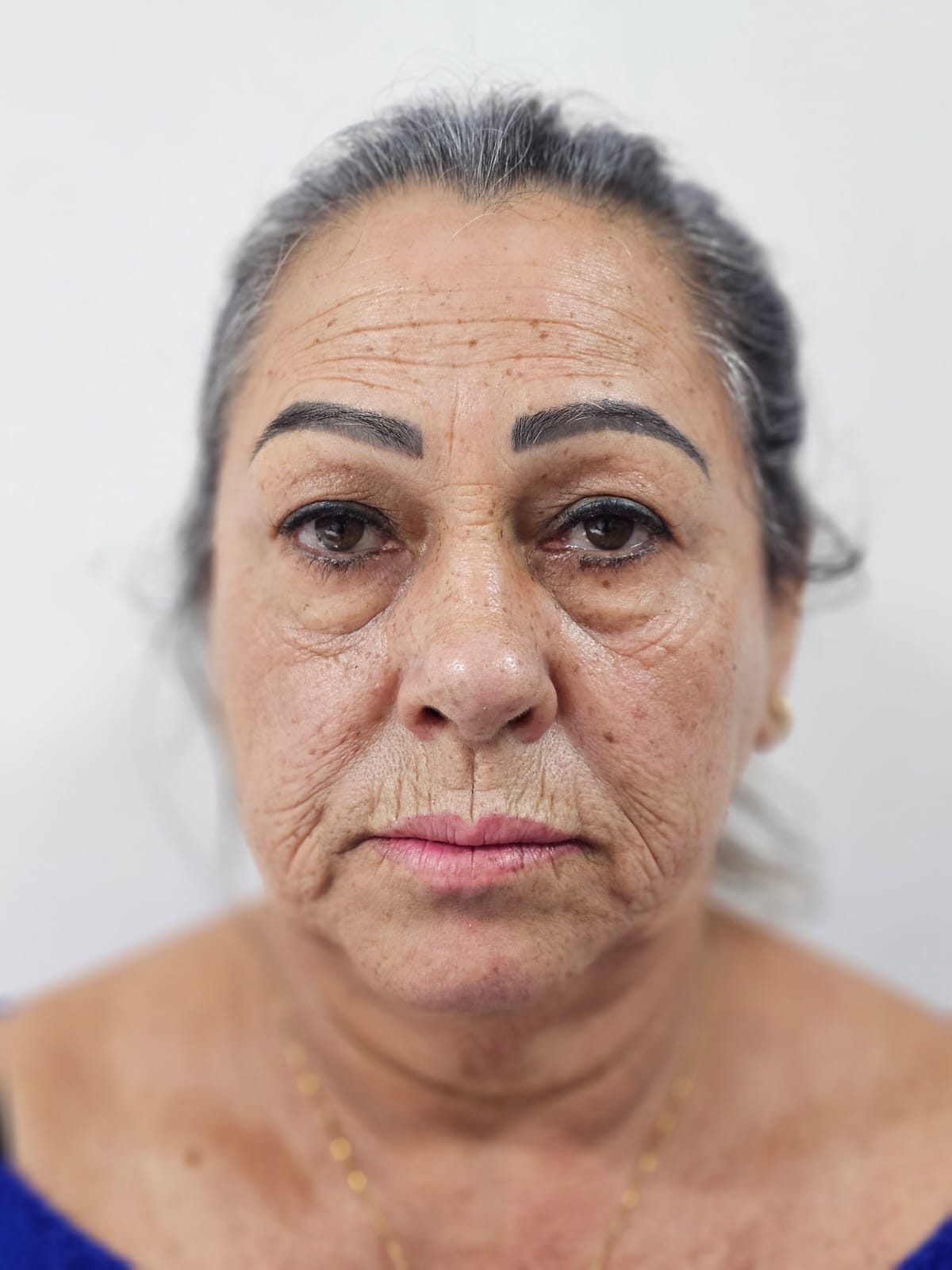 Estética facial: antes