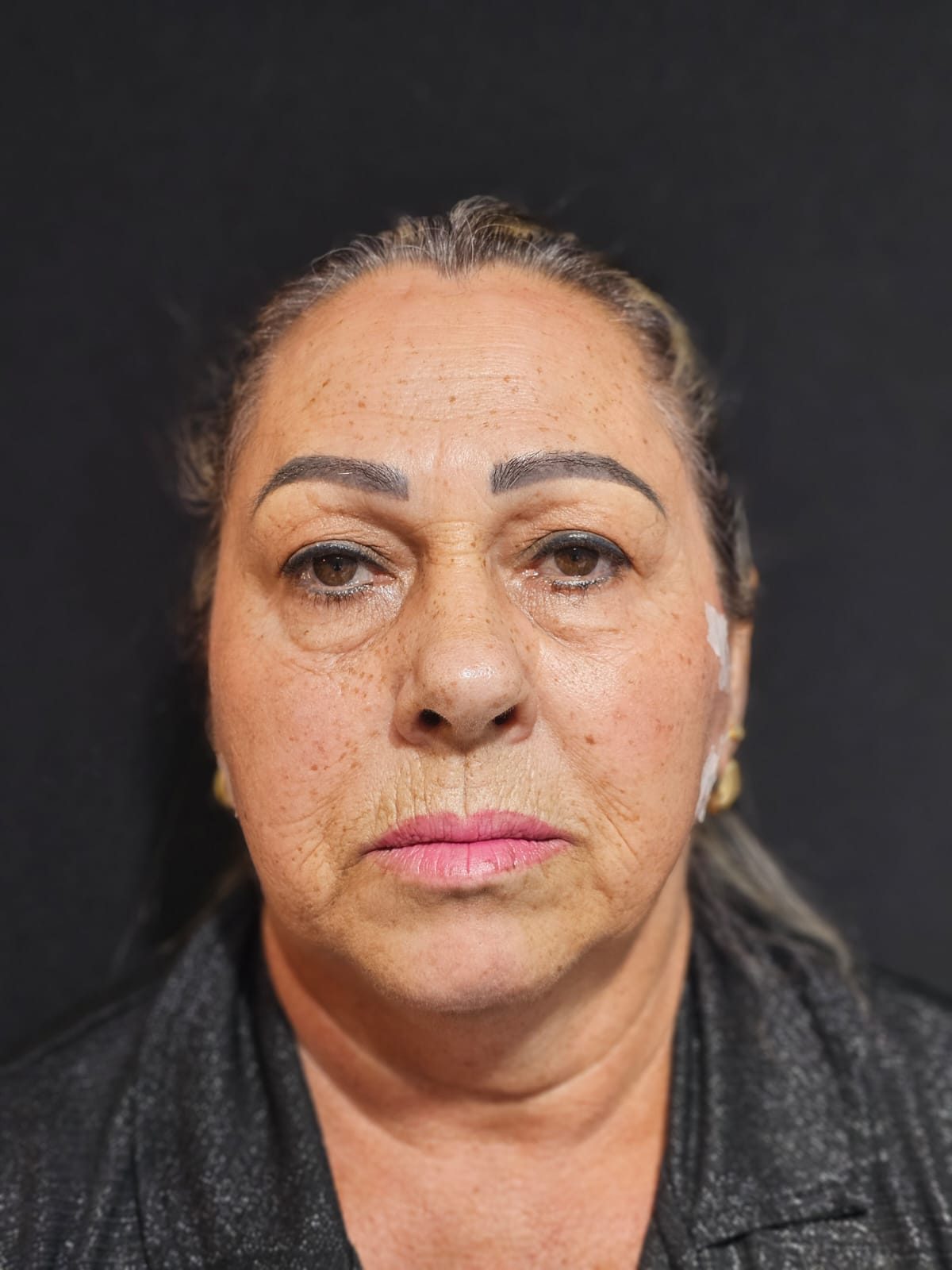 Estética facial: depois