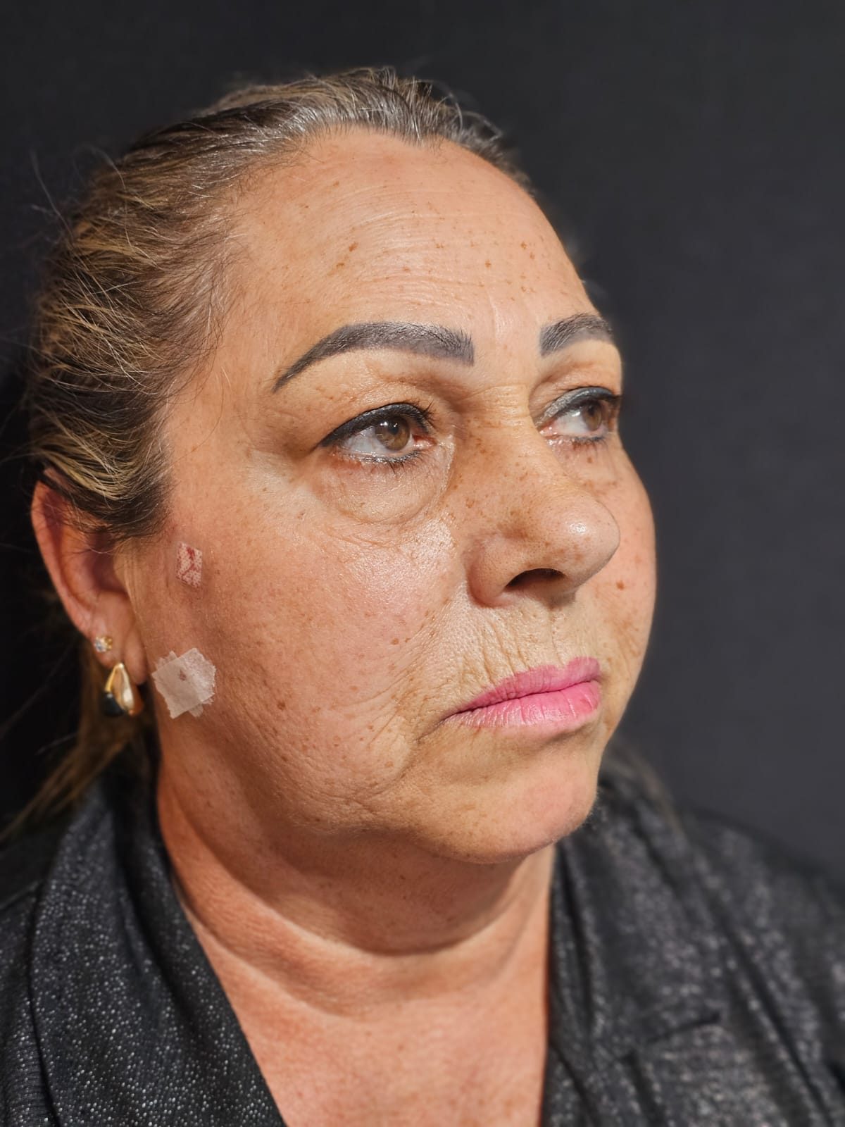 Estética facial: depois
