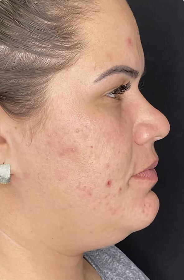 Tratamento de acne e textura: antes