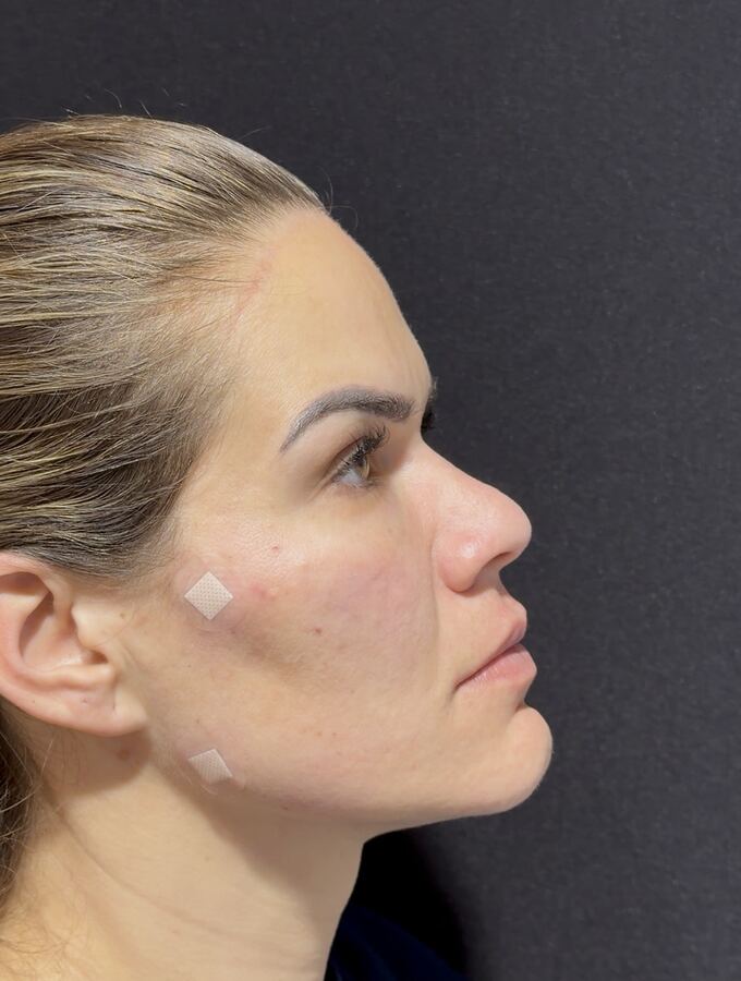 Tratamento de acne e textura: depois