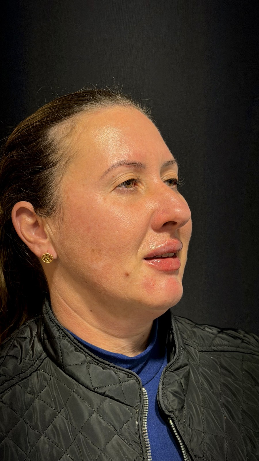 Estética facial: depois